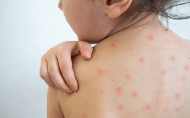 Sarampo volta a preocupar o Brasil e coloca vacinação em alerta; Goiás está há 6 anos sem casos