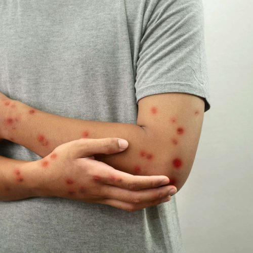Brasil mantém vigilância contra mpox após novos casos confirmados, informa Ministério da Saúde